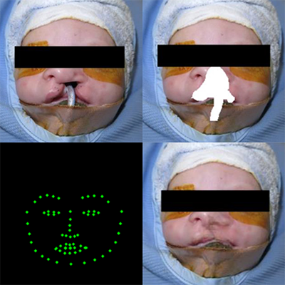 A Feasibility Study on Image Inpainting for Non-Cleft Lip Generation from Patients with Cleft Lip