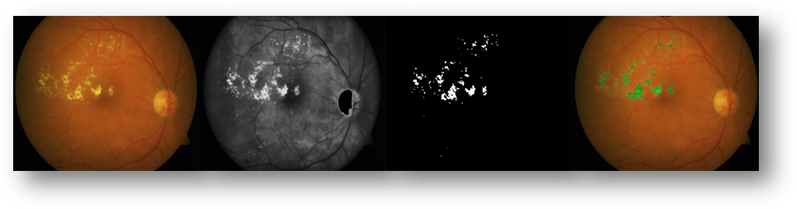 An Intelligent Mobile-Based Automatic Diagnostic System to Identify Retinal Diseases using Mathematical Morphological Operations