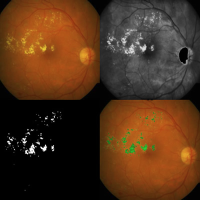 An Intelligent Mobile-Based Automatic Diagnostic System to Identify Retinal Diseases using Mathematical Morphological Operations
